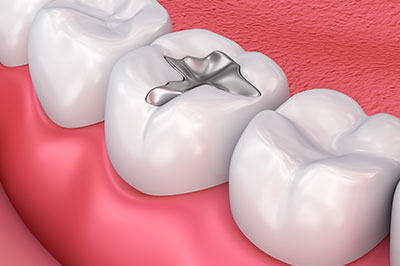 Modern Dental Care of Queens | Veneers, Inlays  amp  Onlays and Invisalign reg 