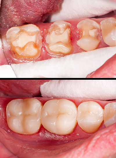 Modern Dental Care of Queens | Dental Cleanings, Dental Bridges and Veneers