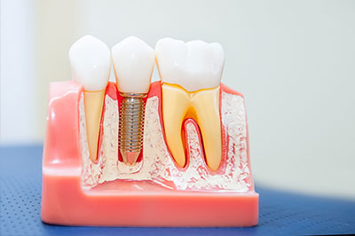 Modern Dental Care of Queens | Implant Restorations, Cosmetic Dentistry and Veneers