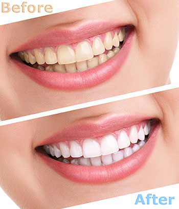 Modern Dental Care of Queens | Dental Sealants, Trios5 reg  Intraoral Scanner and ZOOM  Whitening
