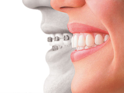 Modern Dental Care of Queens | Dental Sealants, Inlays amp Onlays and Periodontal Treatment